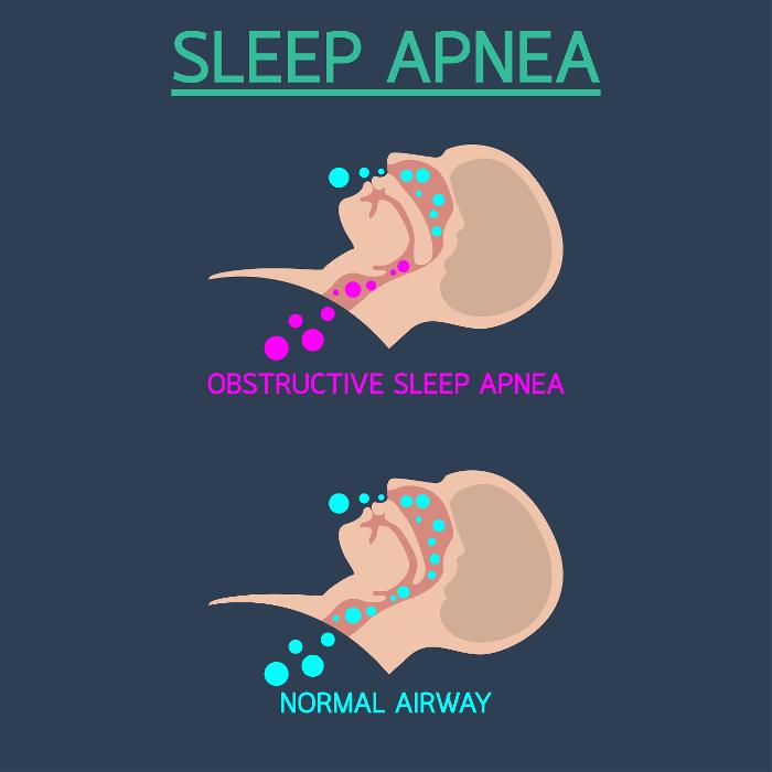 sleep apnea