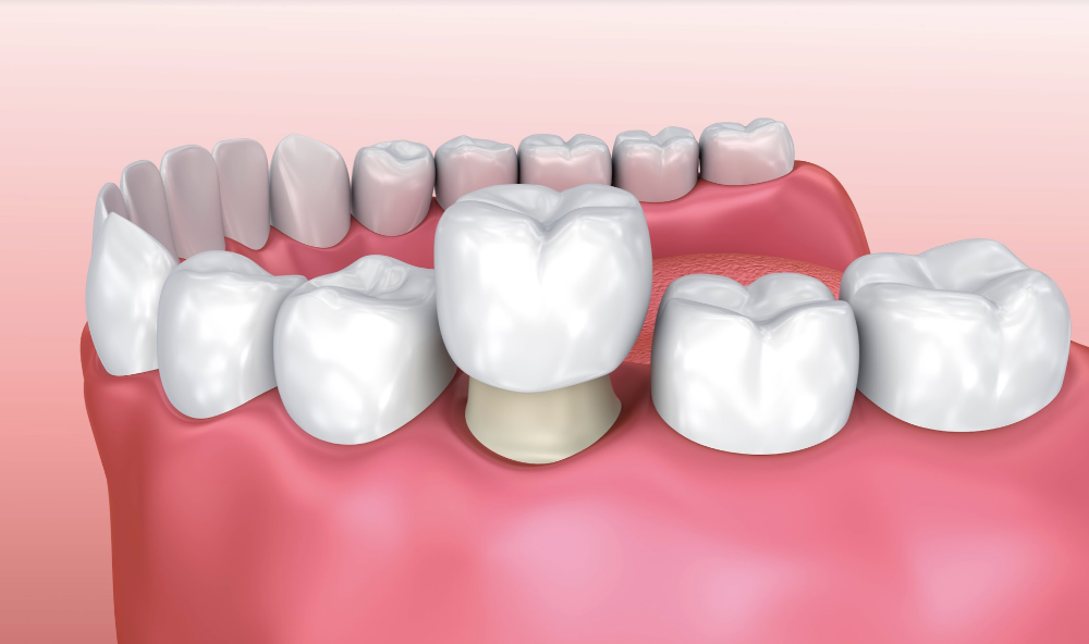 Dental Crown