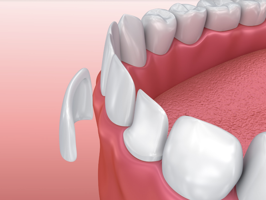 Veneers