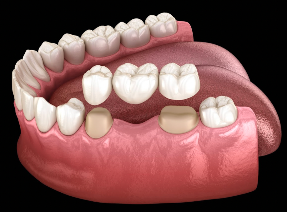 DENTAL CROWNS