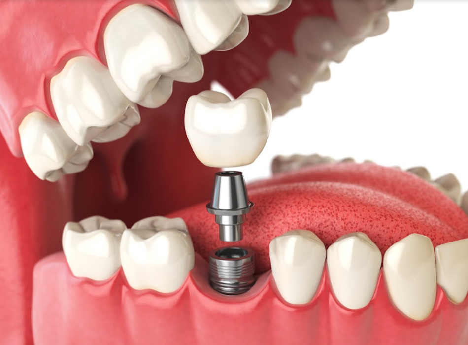 DENTAL IMPLANT